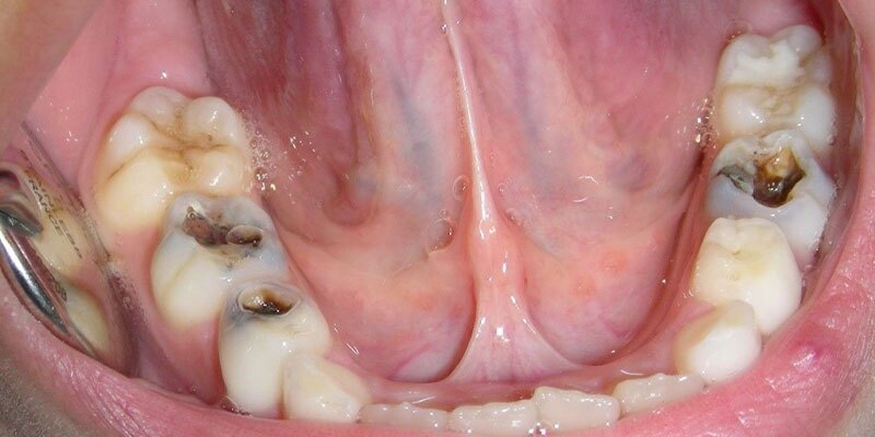 درد دندان؛ علل، تشخیص و درمان انواع آن 