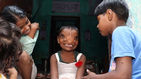 دختر هندی با دو بینی که پرستش می‌شود+عکس