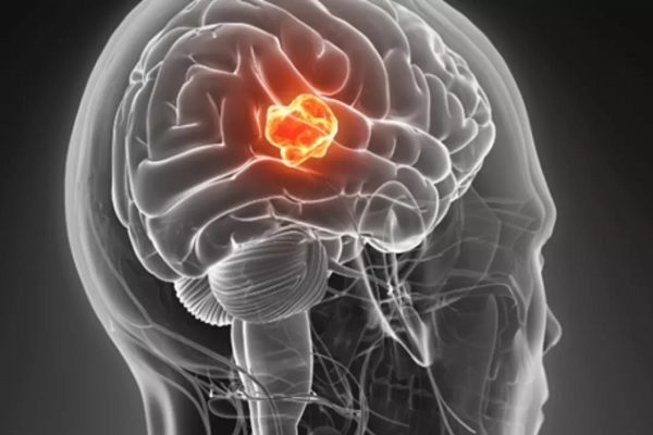 با برخی استراتژی‌ها می‌توانید از بروز تومور مغزی جلوگیری کنید