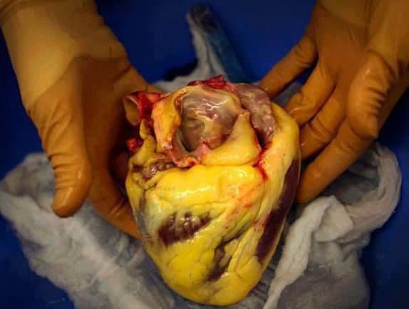 تصویر تکان دهنده از قلب فرد چاقی که با سکته فوت کرد+عکس