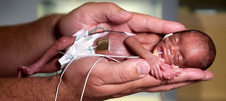 خطر ابتلا به فشار خون بالا در مادرانی که نوزادان نارس به دنیا می‌آورند