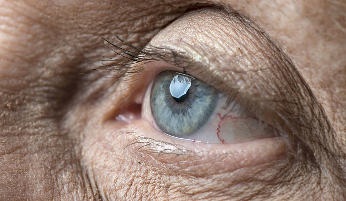 اختلالات بینایی در بیماران مبتلا به پارکینسون شایع است