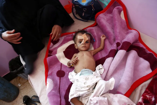تصویر دردناک از نوزاد یمنی دچار سوء تغذیه+عکس