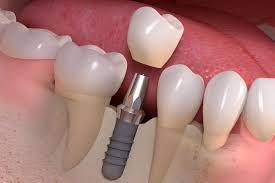 دوره آموزشی جامع ایمپلنت‌های دندانی