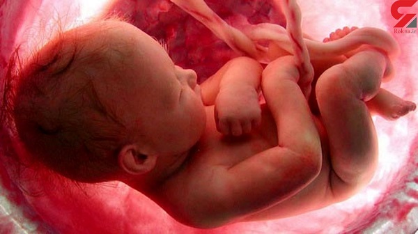 عوارض مختلف سقط جنین+عکس