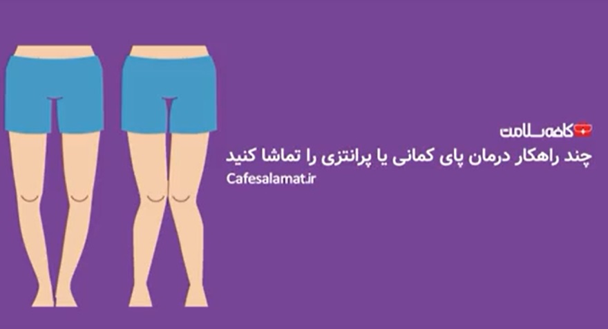 چند راهکار درمان پای کمانی یا پرانتزی را تماشا کنید