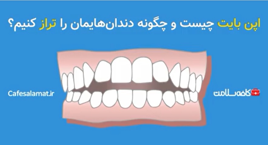 اپن بایت چیست و چگونه دندان‌هایمان را تراز کنیم؟
