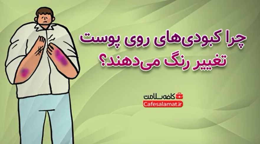 چرا کبودی‌های روی پوست تغییر رنگ می‌دهند؟