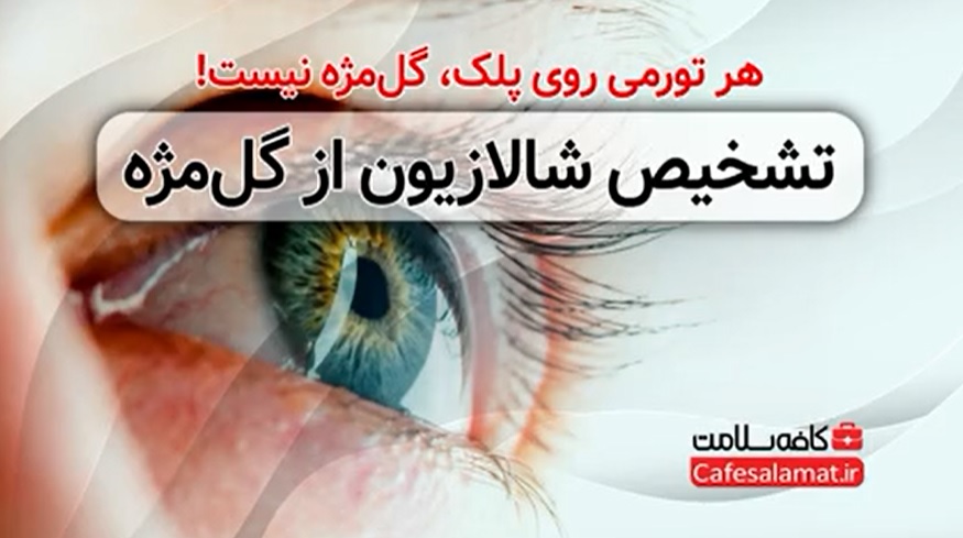 تشخیص شالازیون از گل‌مژه