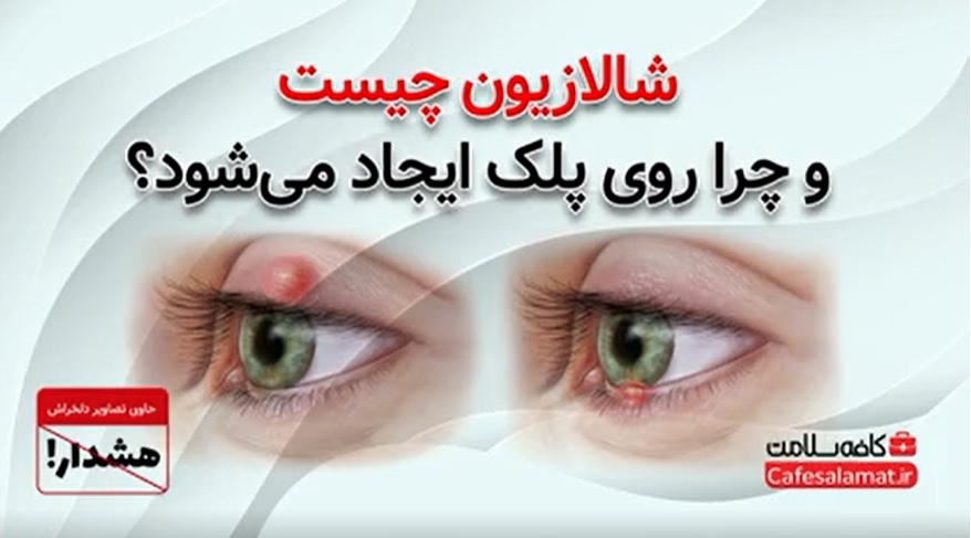 شالازیون چیست و چرا روی پلک ایجاد می‌شود؟