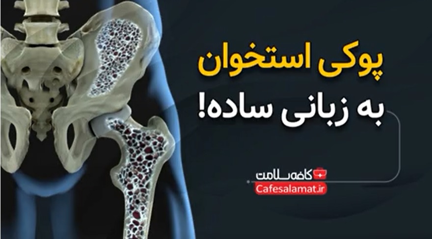 پوکی استخوان به زبانی ساده!