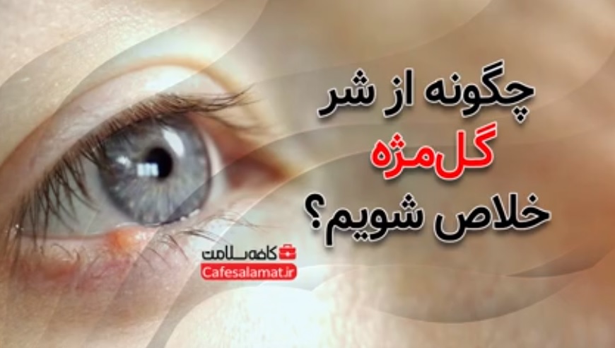 چگونه از شر گل‌مژه خلاص شویم؟