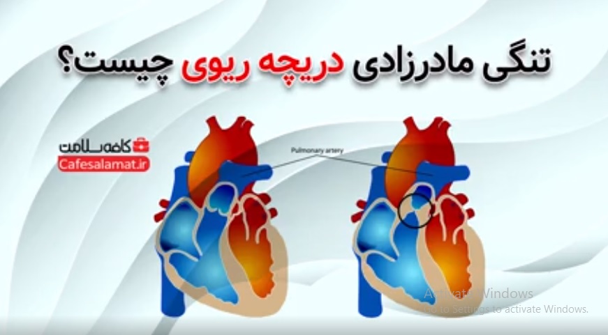 تنگی مادرزادی دریچه ریوی چیست؟