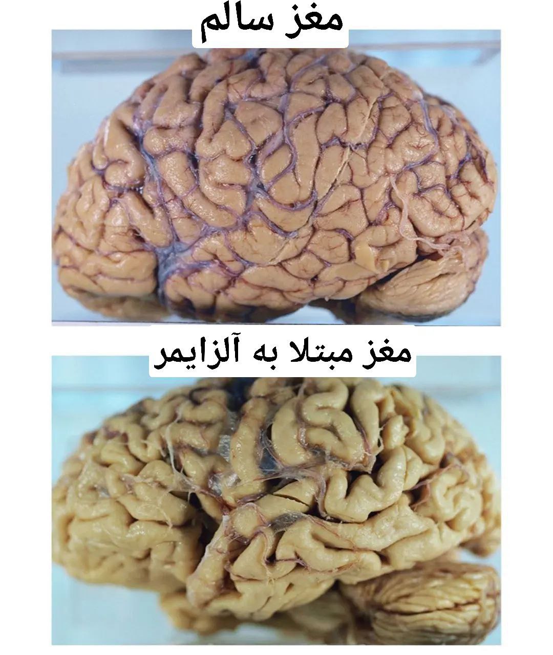تصویر عجیب از مغز یک آلزایمری+عکس