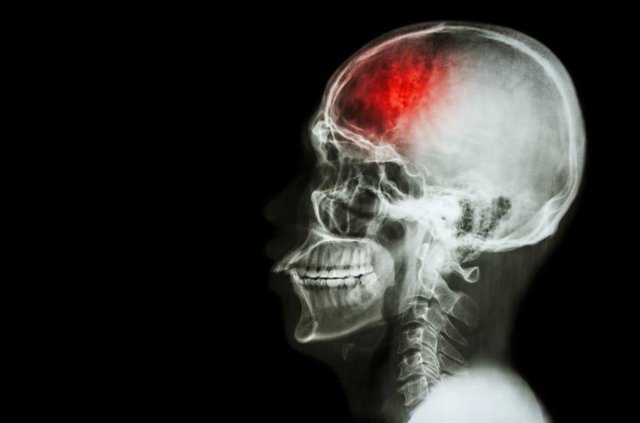 درمان آسیب های مغزی با کمک سلول های بنیادی