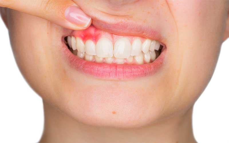 لثه ها به 6 دلیل خونریزی می کنند
