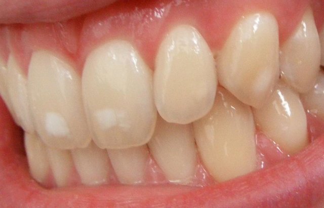 جرم‌گیری برای دندان مضر است؟