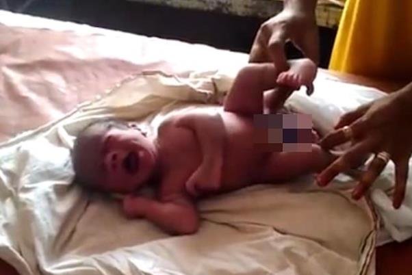 نوزادی با ۴ پا به دنیا آمد +عکس
