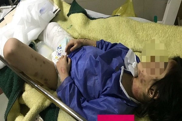 وقوع کودک آزاری با آب داغ! +عکس