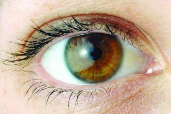 شناسایی مراحل تکوینی تومورهای چشمی در کودکان