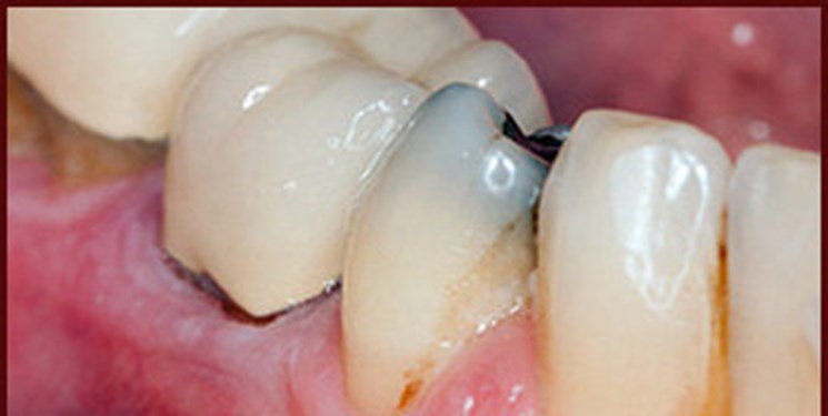«پوسیدگی دندان» سرطان روده را وخیم‌تر می‌کند