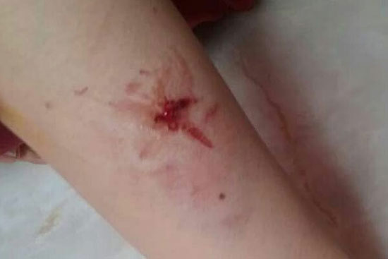 زخمی شدن یک زن پس از حمله سگ‌های ولگرد در لواسان +عکس