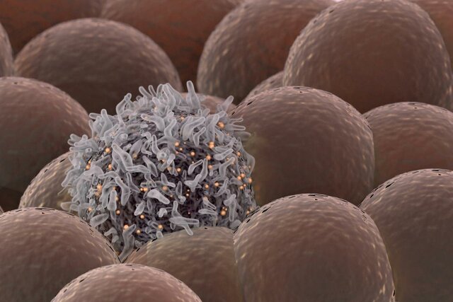 گسترش سلول‌های سرطانی در دو یا سه مرحله صورت می‌گیرد