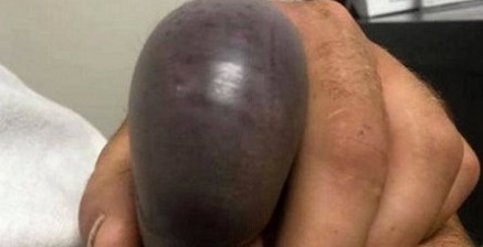 اتفاق عجیب برای انگشت یک مرد +عکس