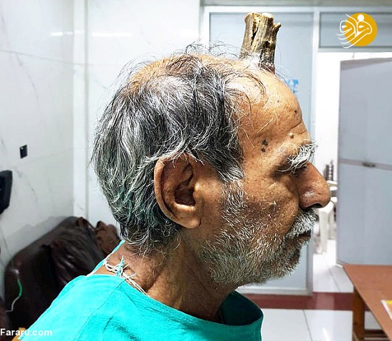شاخ روی سر مرد هندی جراحی شد +عکس