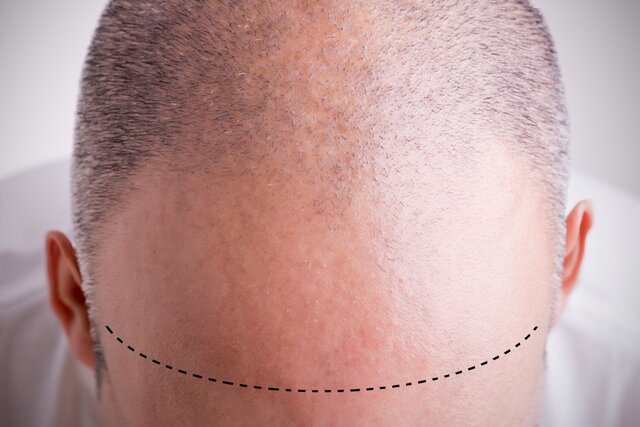  جلوگیری از ریزش مو با مسدود کردن انقباضات غلاف پوستی