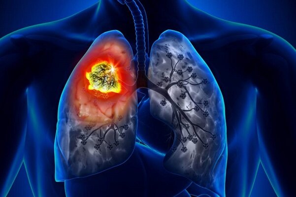 سیستم ایمنی معیوب منجر به سرطان ریه می‌شود