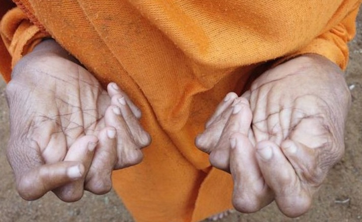 این زن به خاطر انگشتان زیادش به جادوگر معروف شده! +عکس 