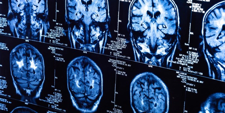 شواهد جدید از ارتباط روده و مغز در بیماری پارکینسون