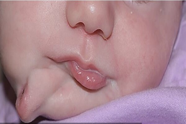 تولد نوزاد دختر با دو دهان+عکس