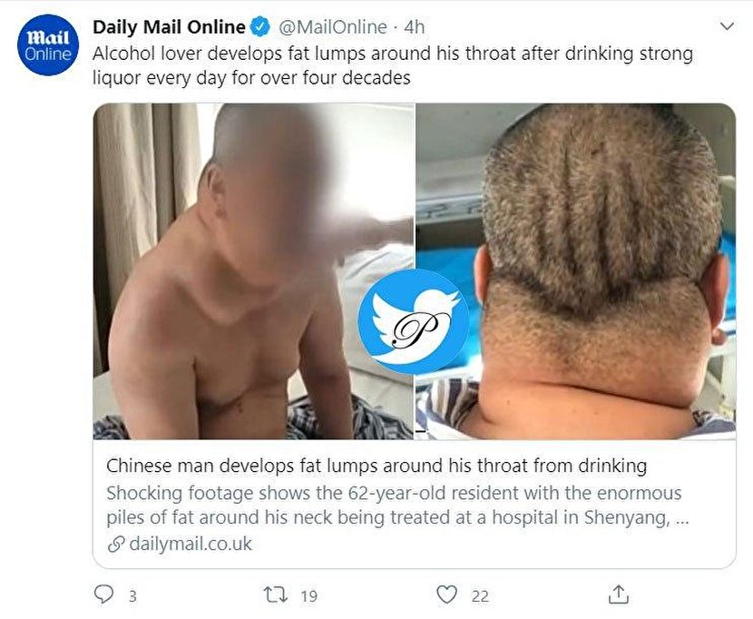 اعتیاد به الکل مرد چینی را این شکلی کرد+عکس
