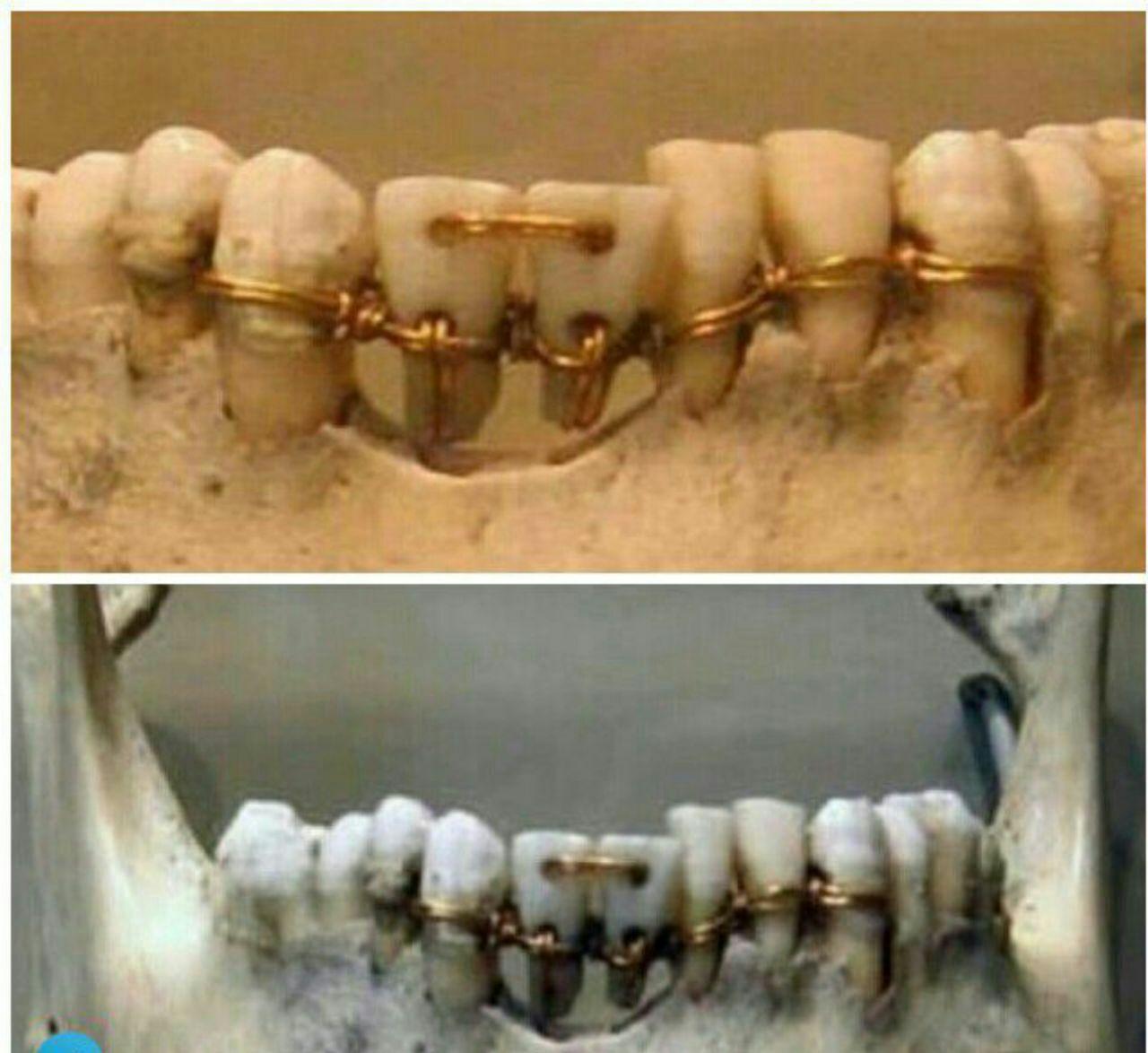 ارتودنسی دندان مردگان در مصر باستان+عکس
