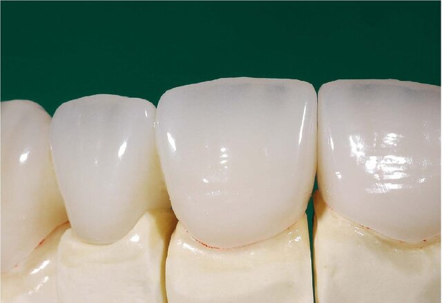 امکان ساخت دندان‌های سرامیکی در کشور فراهم شد