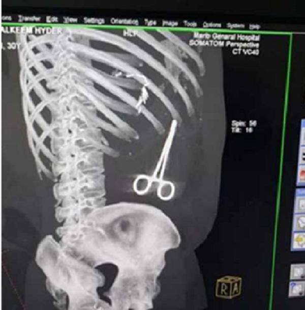 قیچی جراحی در معده بیمار بیچاره+عکس