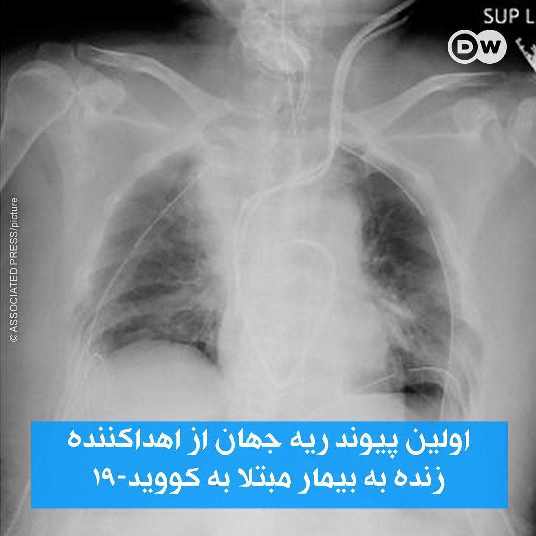 اولین پیوند ریه جهان به بیمار کرونایی با موفقیت انجام شد+عکس