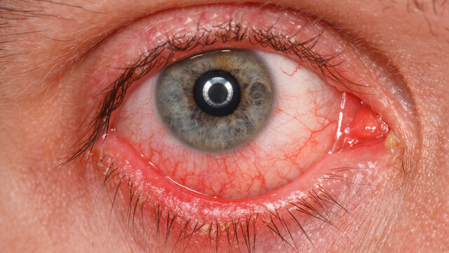 مشاهده شواهدی مبنی بر ابتلای سلول‌های چشم به کووید-۱۹
