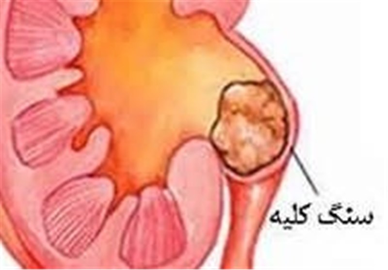 کشف داروی جدید برای دفع راحت‌تر  سنگ کلیه  