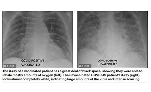 تصویر حیرت انگیز از فرد مبتلا به کرونا قبل و بعد از واکسن +عکس